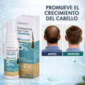 Spray Minoxidil